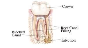 root canal retreatment