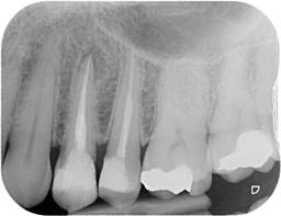 root canal retreatments