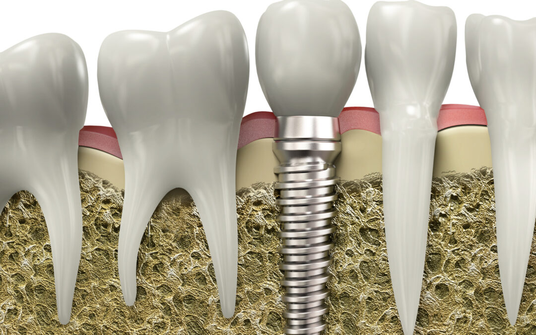 The benefits of dental implants